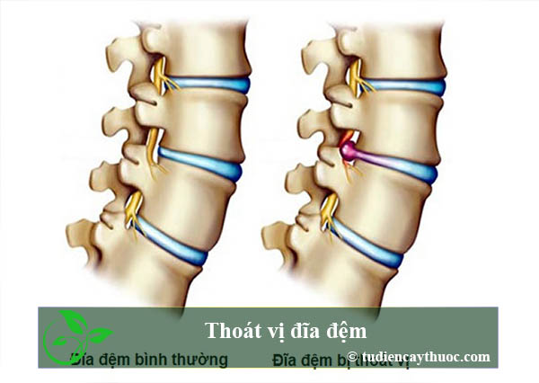 Thoát vị đĩa đệm