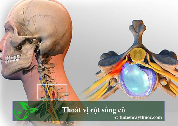 Thoát vị cột sống cổ Thoát vị cột sống cổ