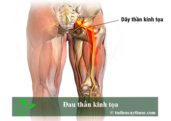 Đau thần kinh tọa