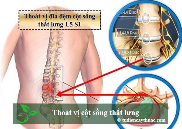 thoát vị cột sống lưng
