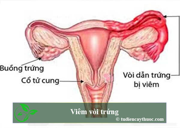 Viêm vòi trứng Viêm vòi trứng