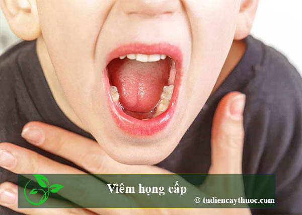 Viêm họng cấp