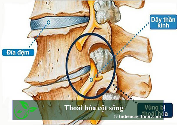 Thoái hóa cột sống
