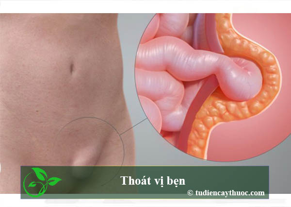 Thoát vị bẹn