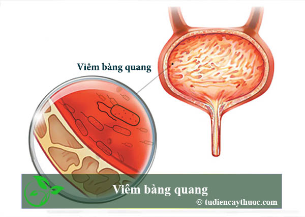 Viêm bàng quang Viêm bàng quang