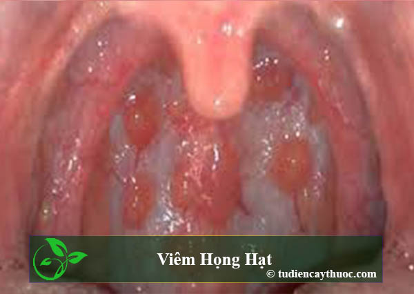 viêm họng hạt