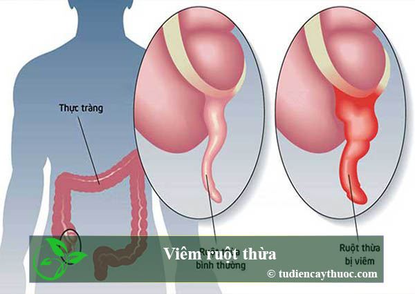 Viêm ruột thừa