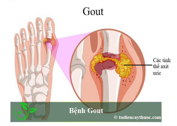 bệnh gút kiêng ăn gì và nên ăn gì