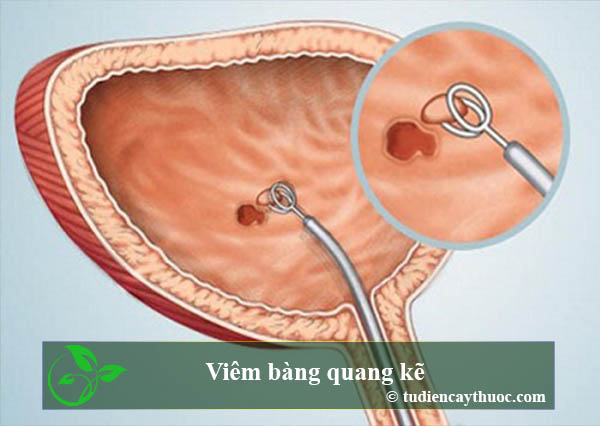 Viêm bàng quang kẽ