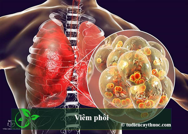 Viêm phổi