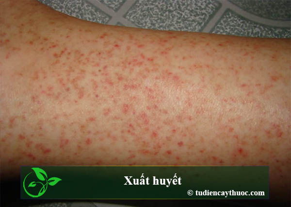 xuất huyết xuất huyết