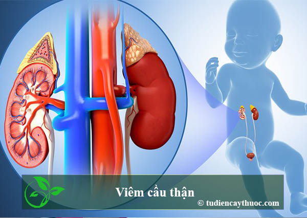 viêm cầu thận